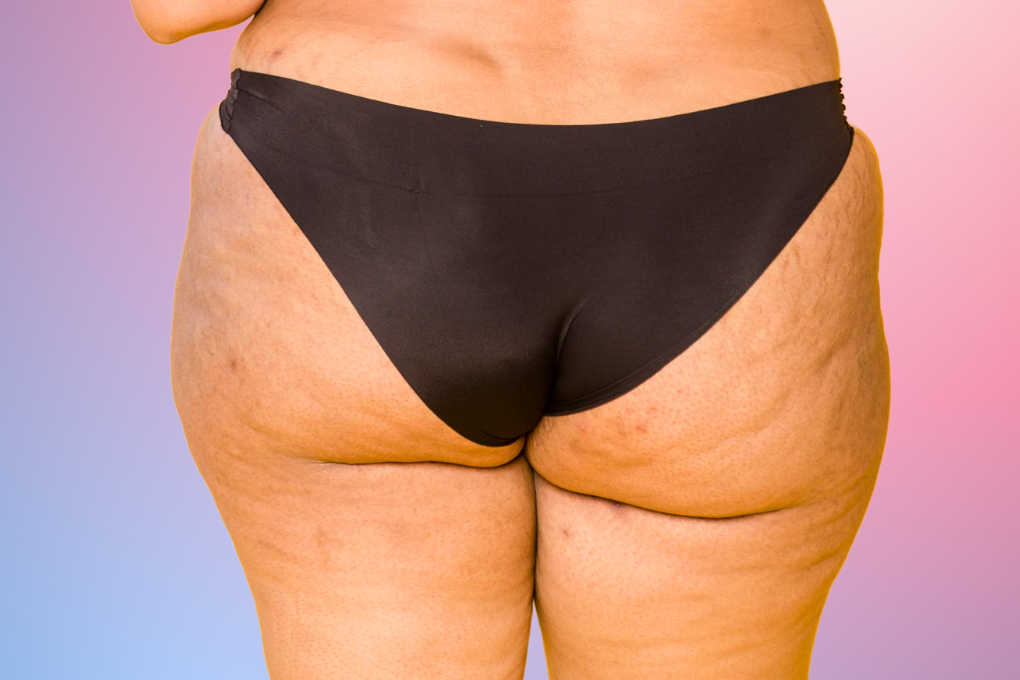 Photo of pimples on butt