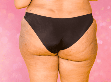 Picture of woman's butt in black underwear with some hyperpigmentation from pimples