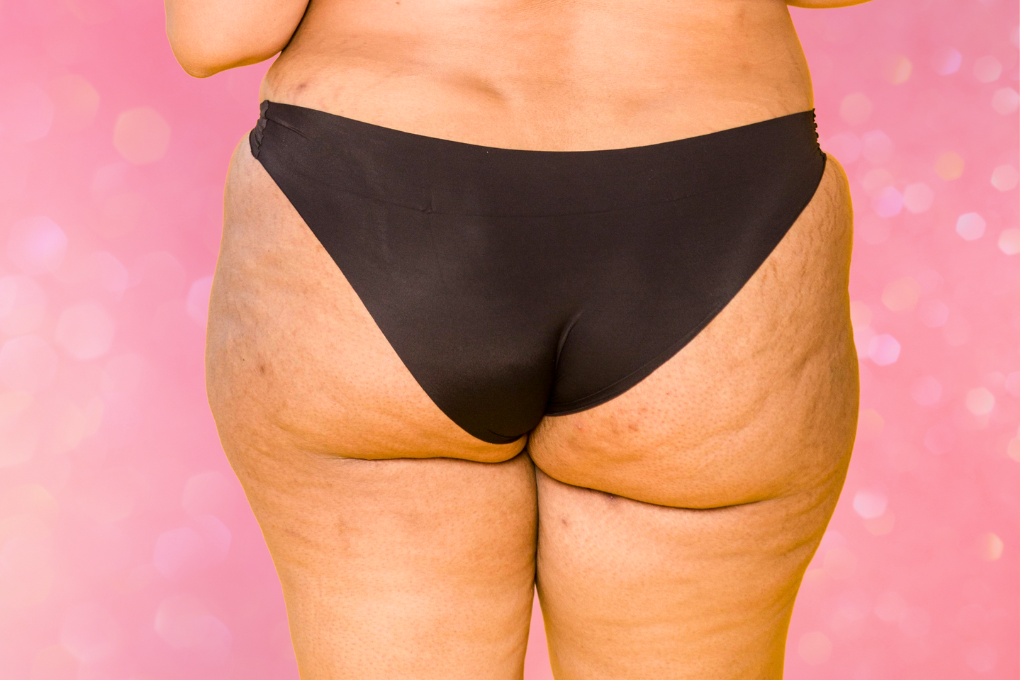 Picture of woman's butt in black underwear with some hyperpigmentation from pimples