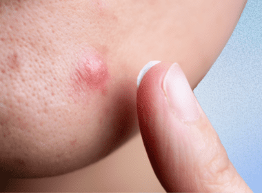 Close up of cystic pimple with finger about to apply treatment