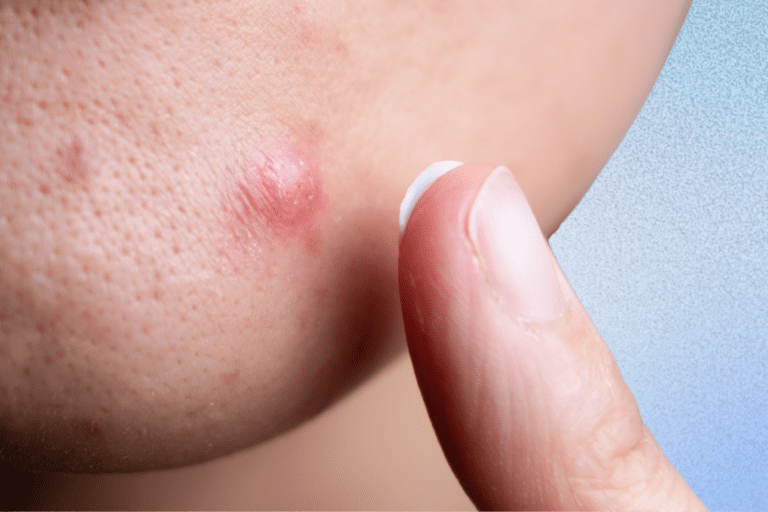 Close up of cystic pimple with finger about to apply treatment