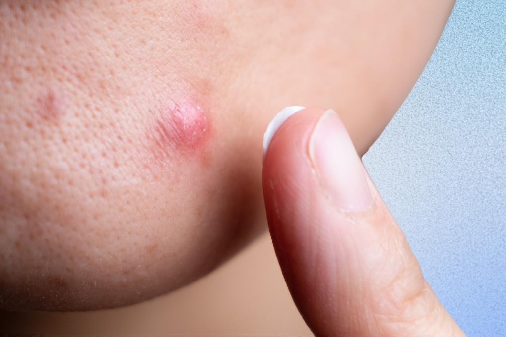 Close up of cystic pimple with finger about to apply treatment