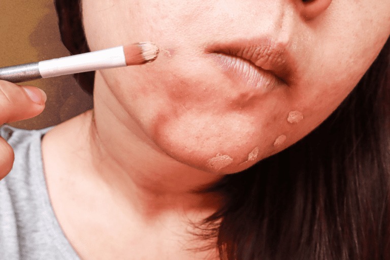 Woman applying concealer to pimples